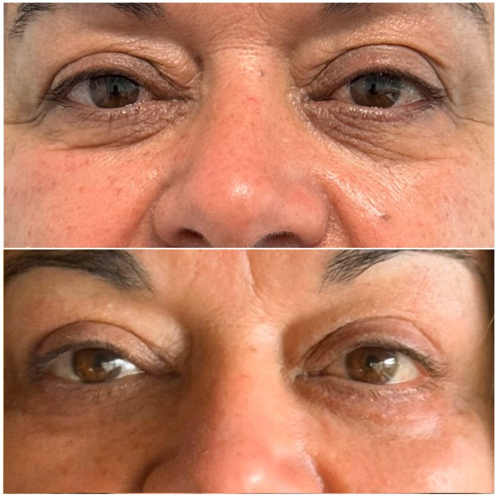 Blefaroplastia superior e inferior 1 mês pós-operatório