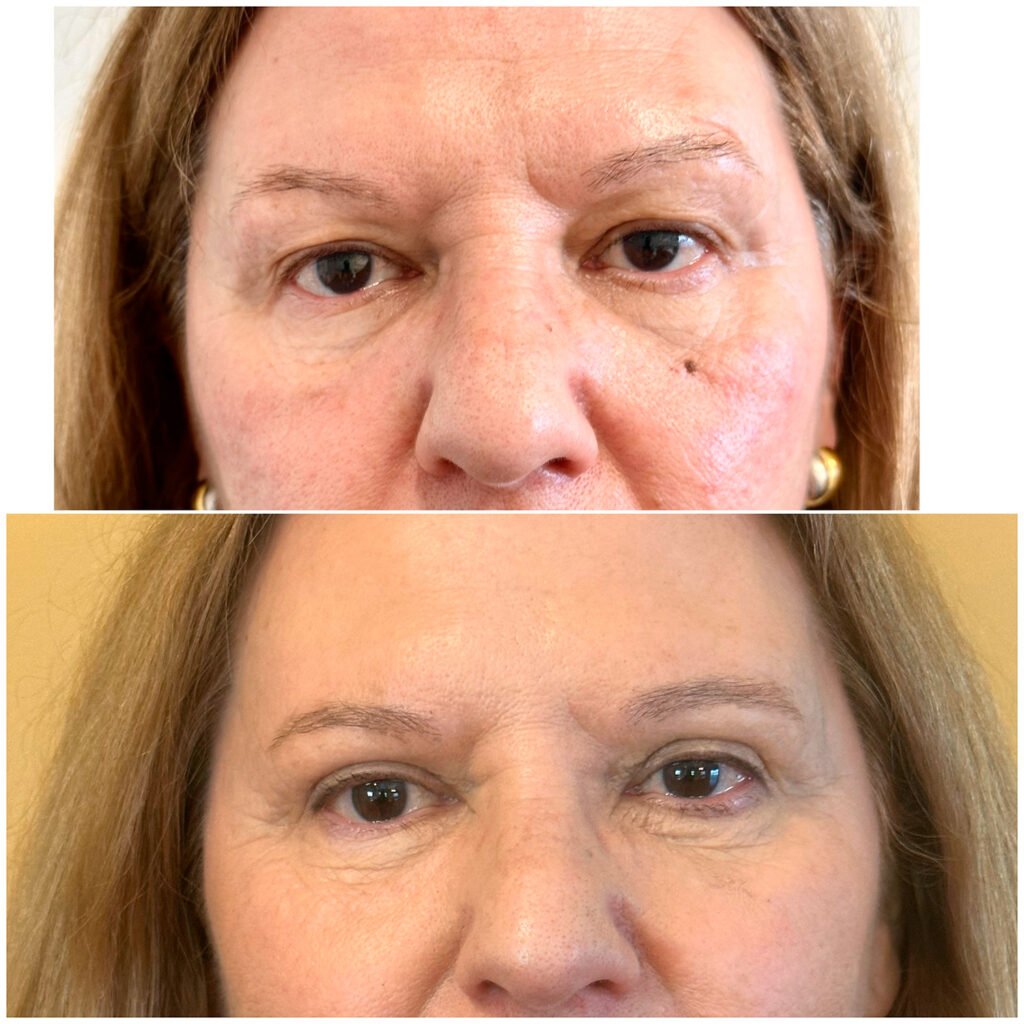 Blefaroplastia superior e remoção de nevo (sinal) da face 2 meses pós-operatório