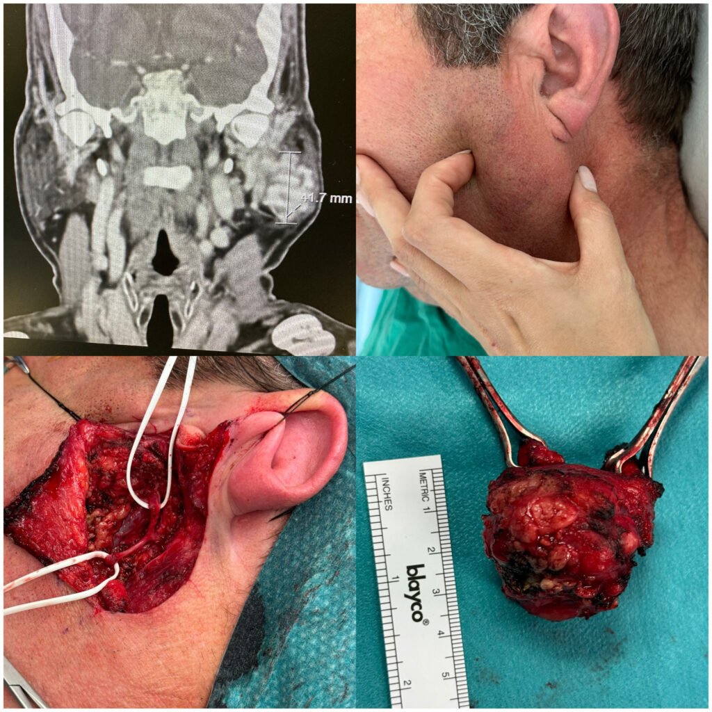 Exérese de um tumor da glândula parótida com preservação do nervo facial