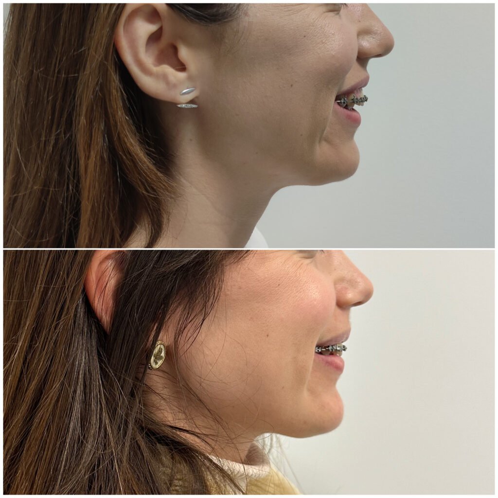 Cirurgia Ortognática bimaxilar - Correção do sorriso gengival, falta de projeção do mento, overjet dentário, incompetência labial, subida da ponta nasal