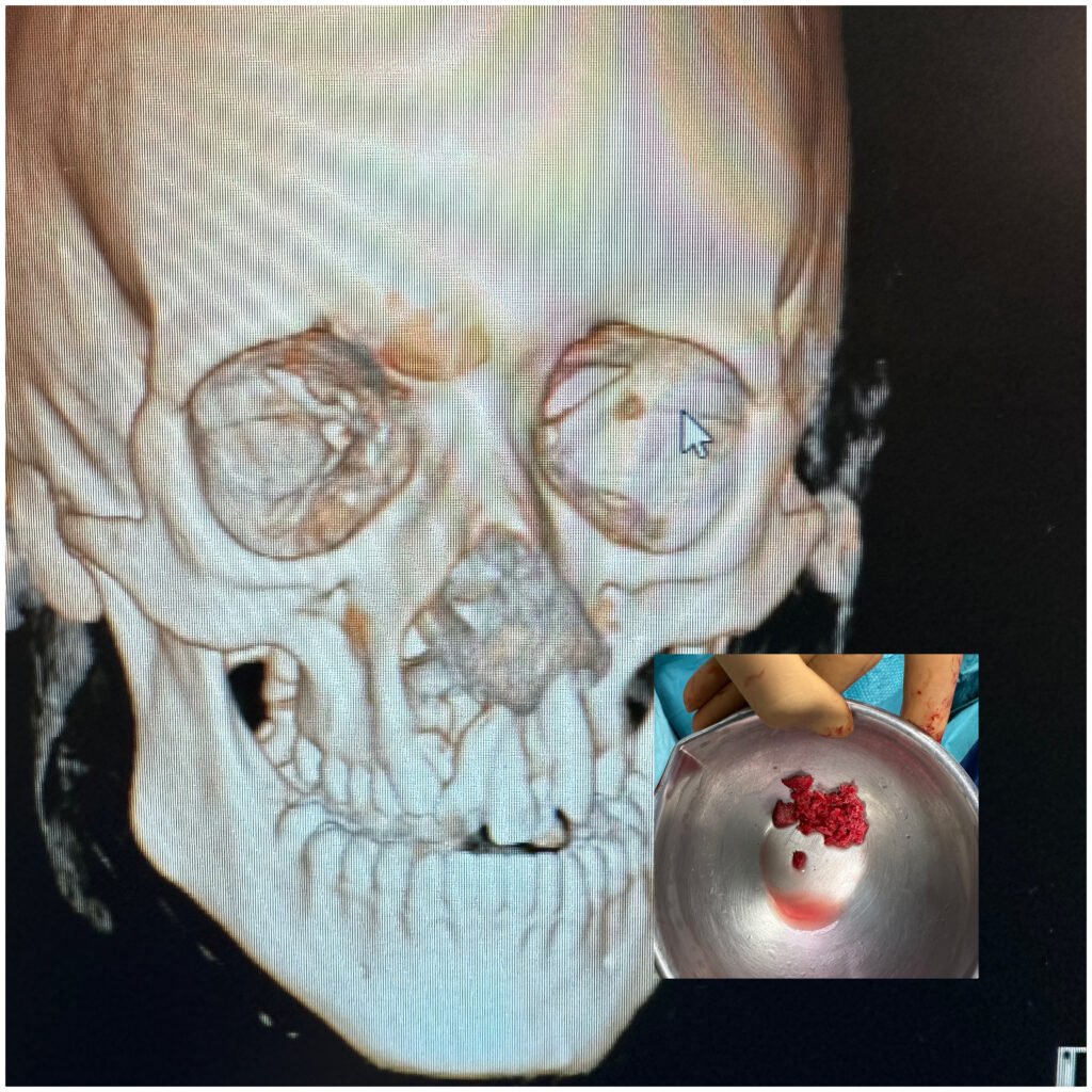 Doente com fenda labiopalatina (enxerto ósseo de crista ilíaca para encerrar feito ósseo maxilar)