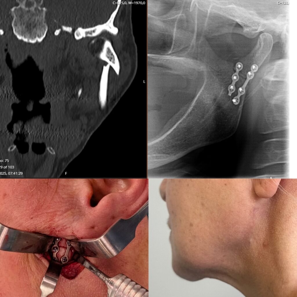 Fratura do côndilo mandibular – 2 semanas pós operatório com cicatriz quase invisível
