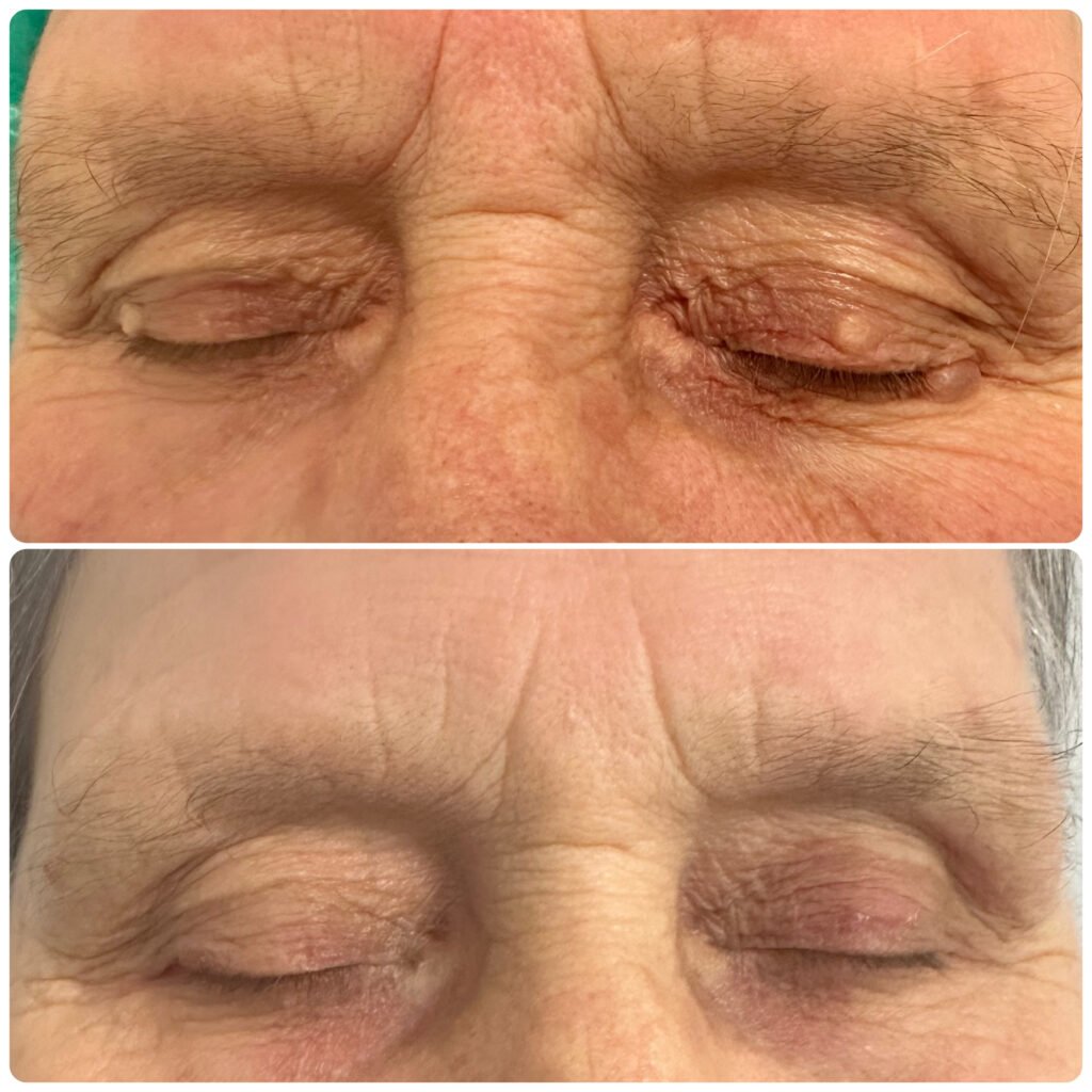 Excisão de fibromas da pálpebra superior e inferior 15 dias pós-operatório