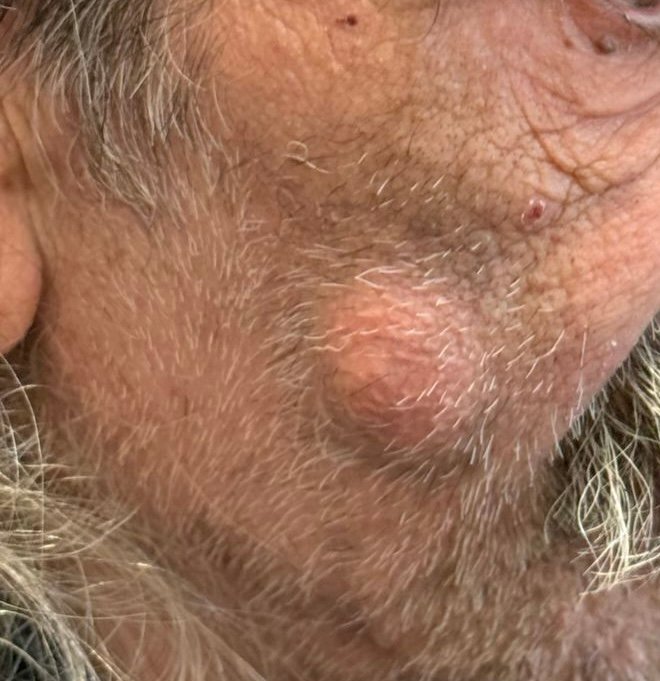 Lipoma da Face