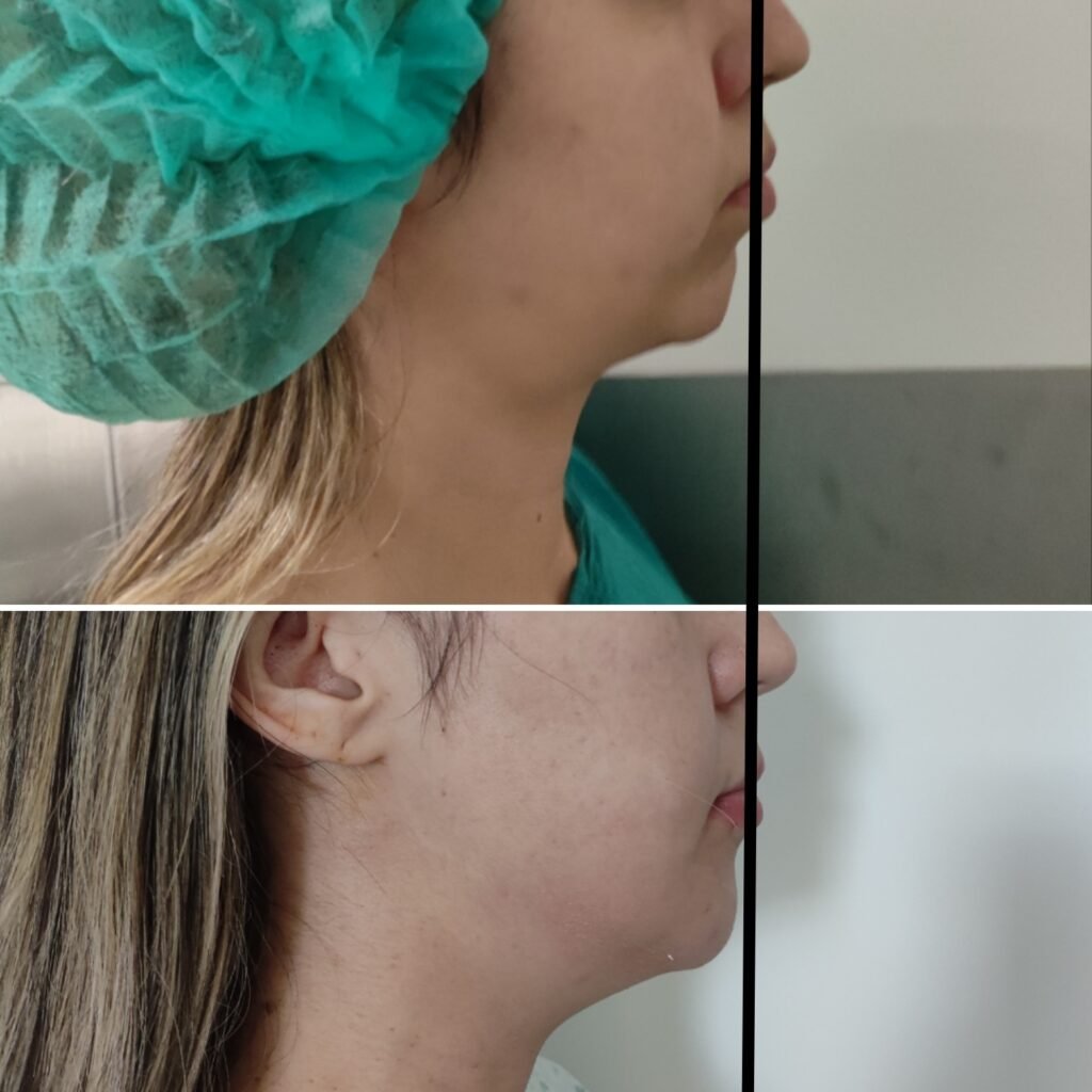 1 mês pós operatório de mentoplastia de avanço