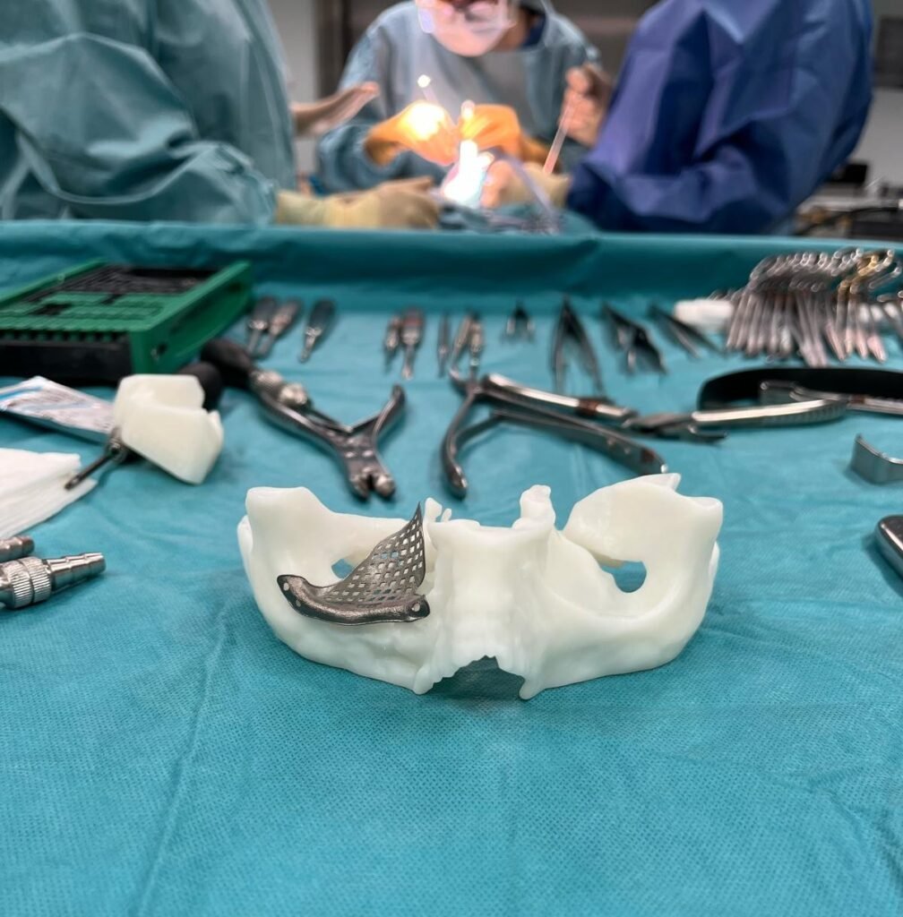 Placa feita à medida para reconstrução do pavimento da órbita (colocada via transconjutival - por dentro da pálpebra, de forma a evitar cicatrizes)