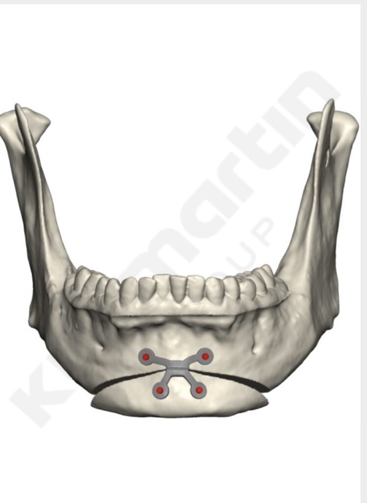 Placa feita à medida.