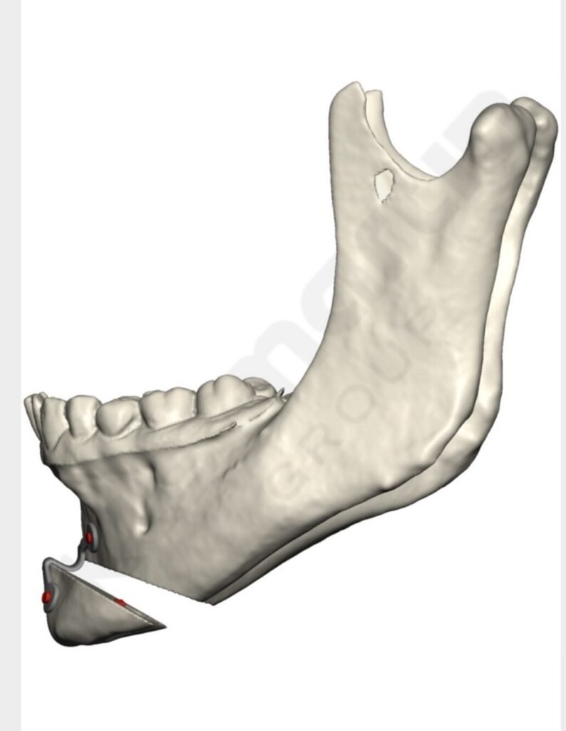Planificação 3D de caso de avanço e rotação do mento.