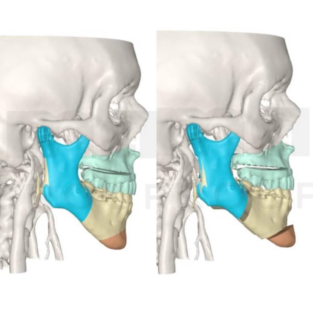 Planificação de doente para cirurgia ortognática bimaxilar e mentoplastia