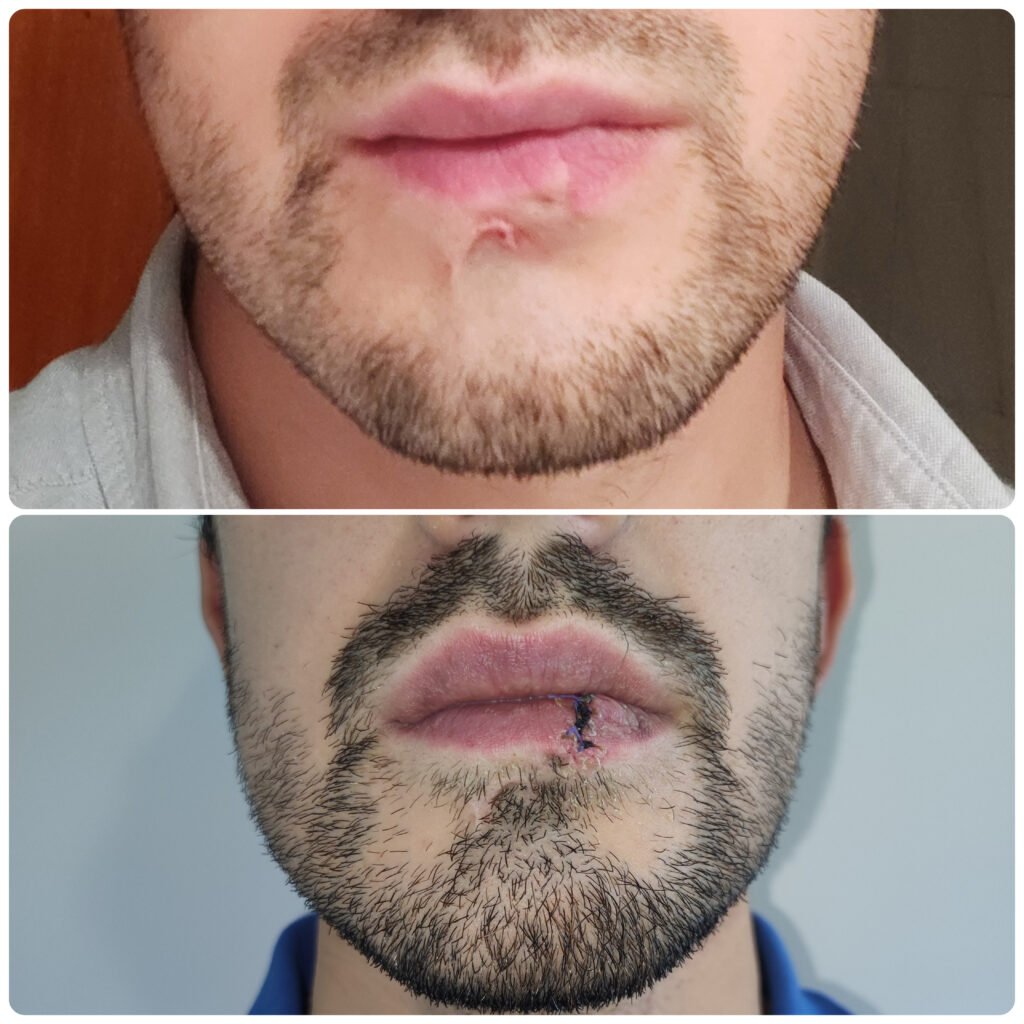 7 dias pós-operatório: plastia de cicatriz do lábio (melhoria da transição pele-vermelhão)