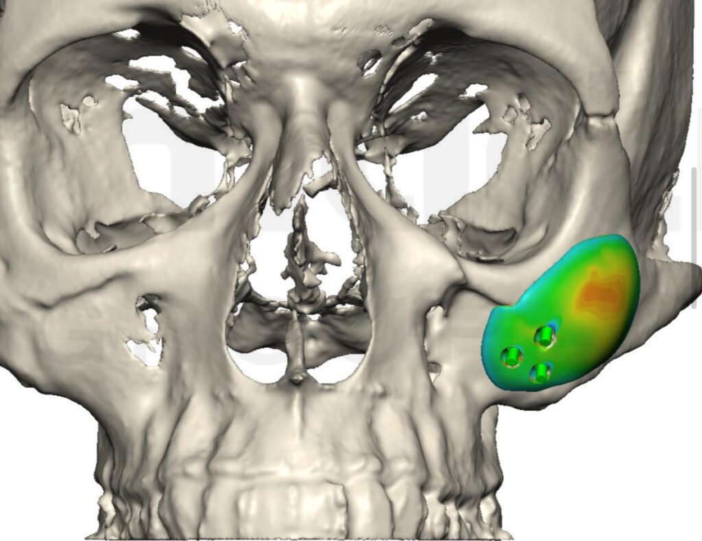 Caso de implante malar