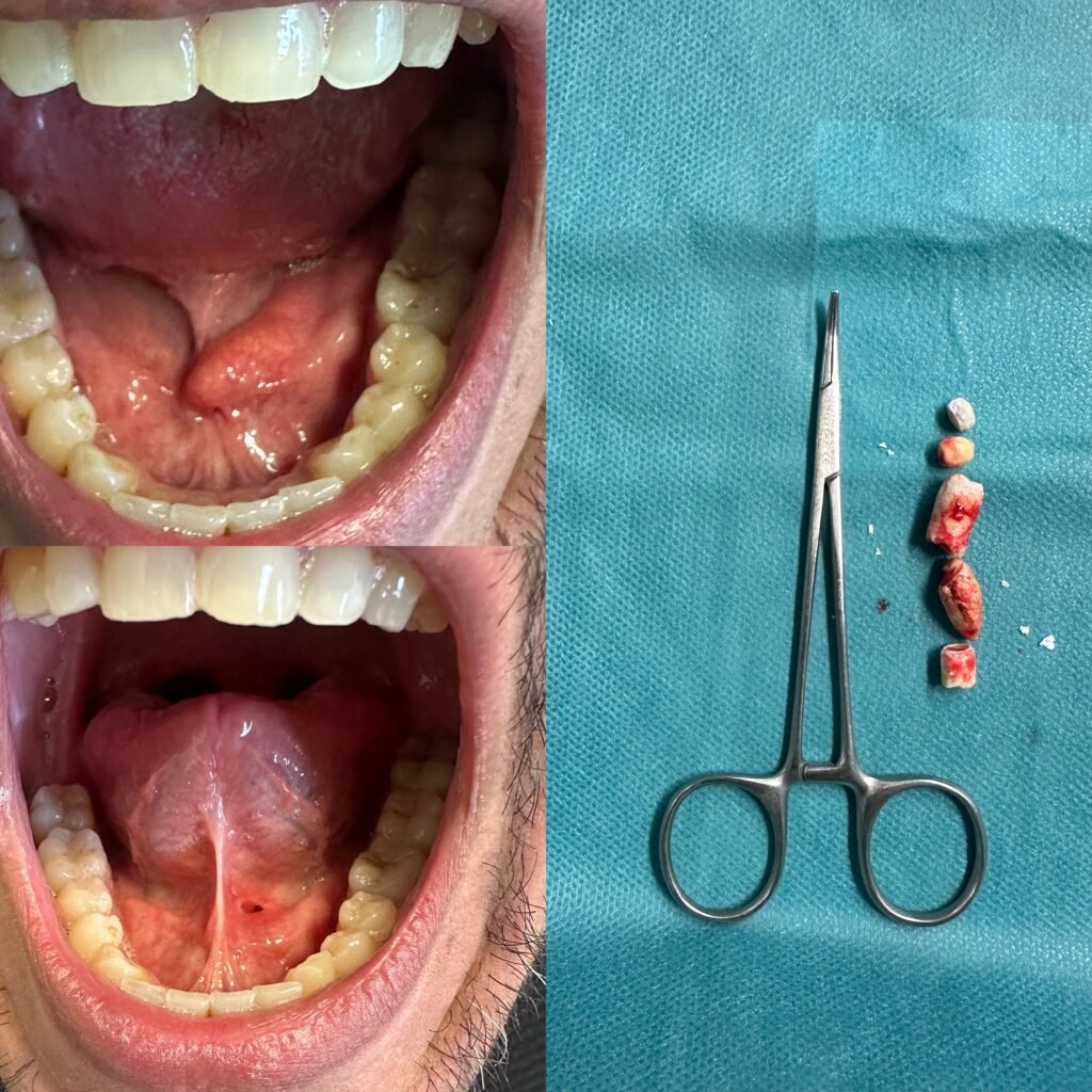 Sialolitotomia - excisão de cálculos do ducto salivar