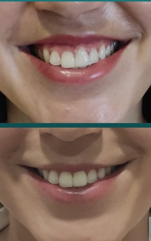 Tratamento do sorriso gengival com Toxina Botulínica